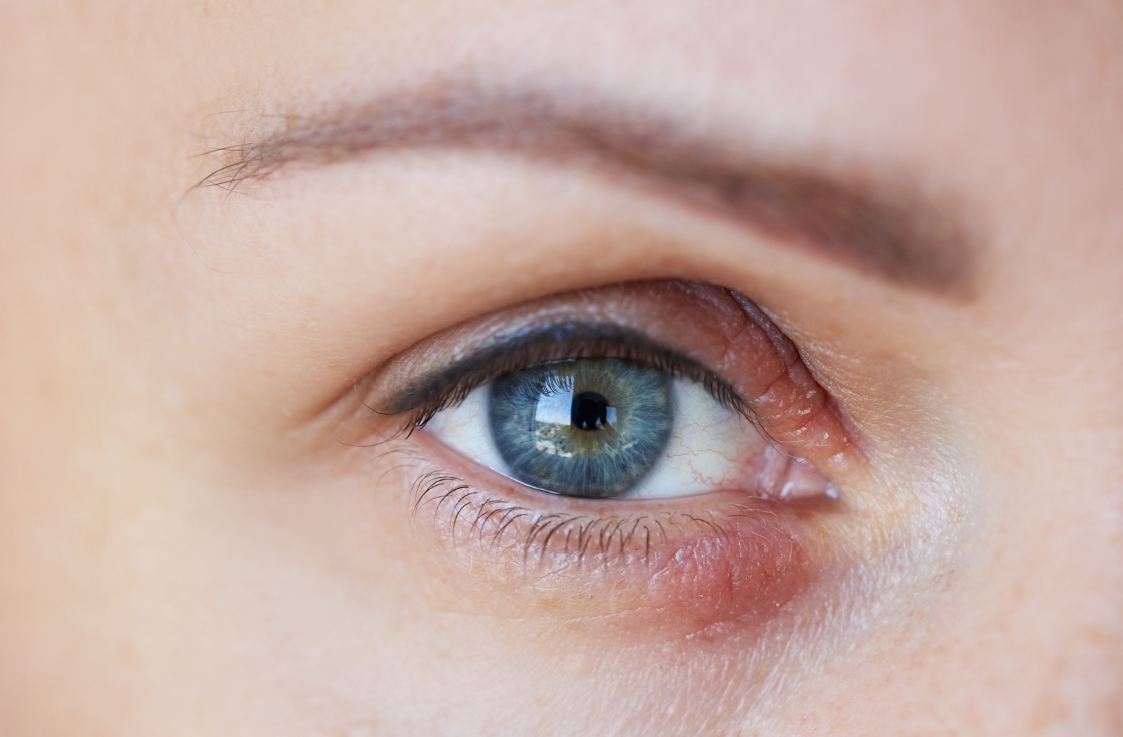 A person with anterior blepharitis stares ahead. The skin around their eyelid is dry and irritated.