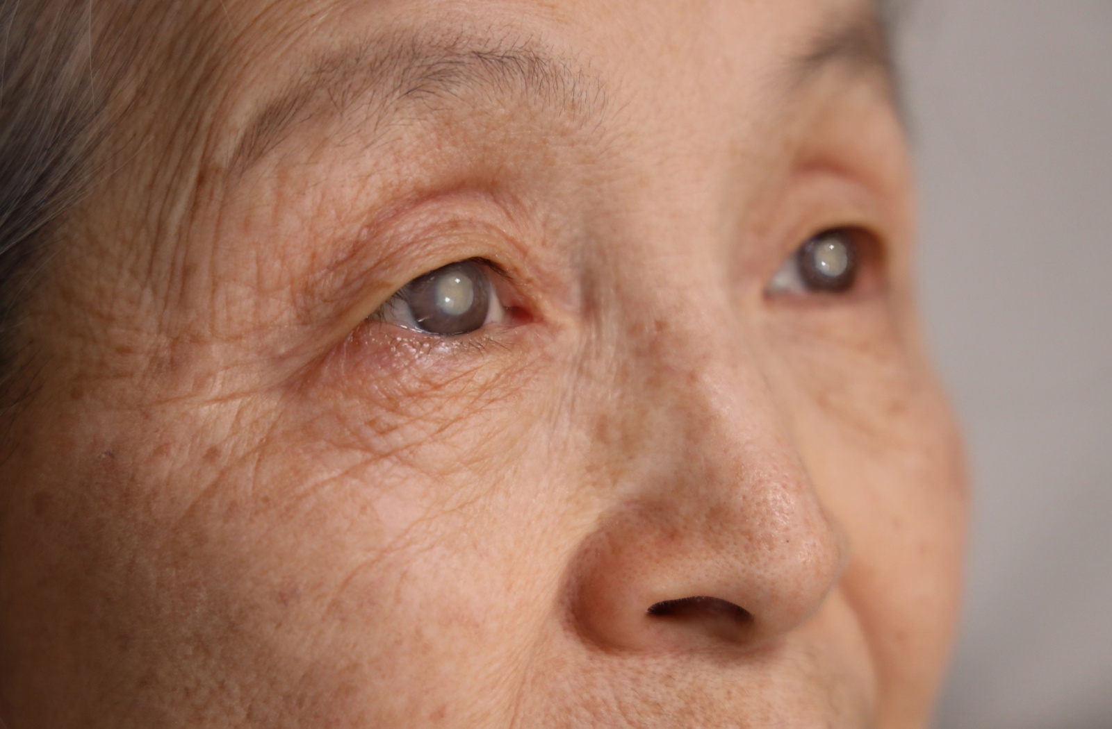 Close-up of a person’s eyes showing visible cloudiness which is an early sign of cataracts