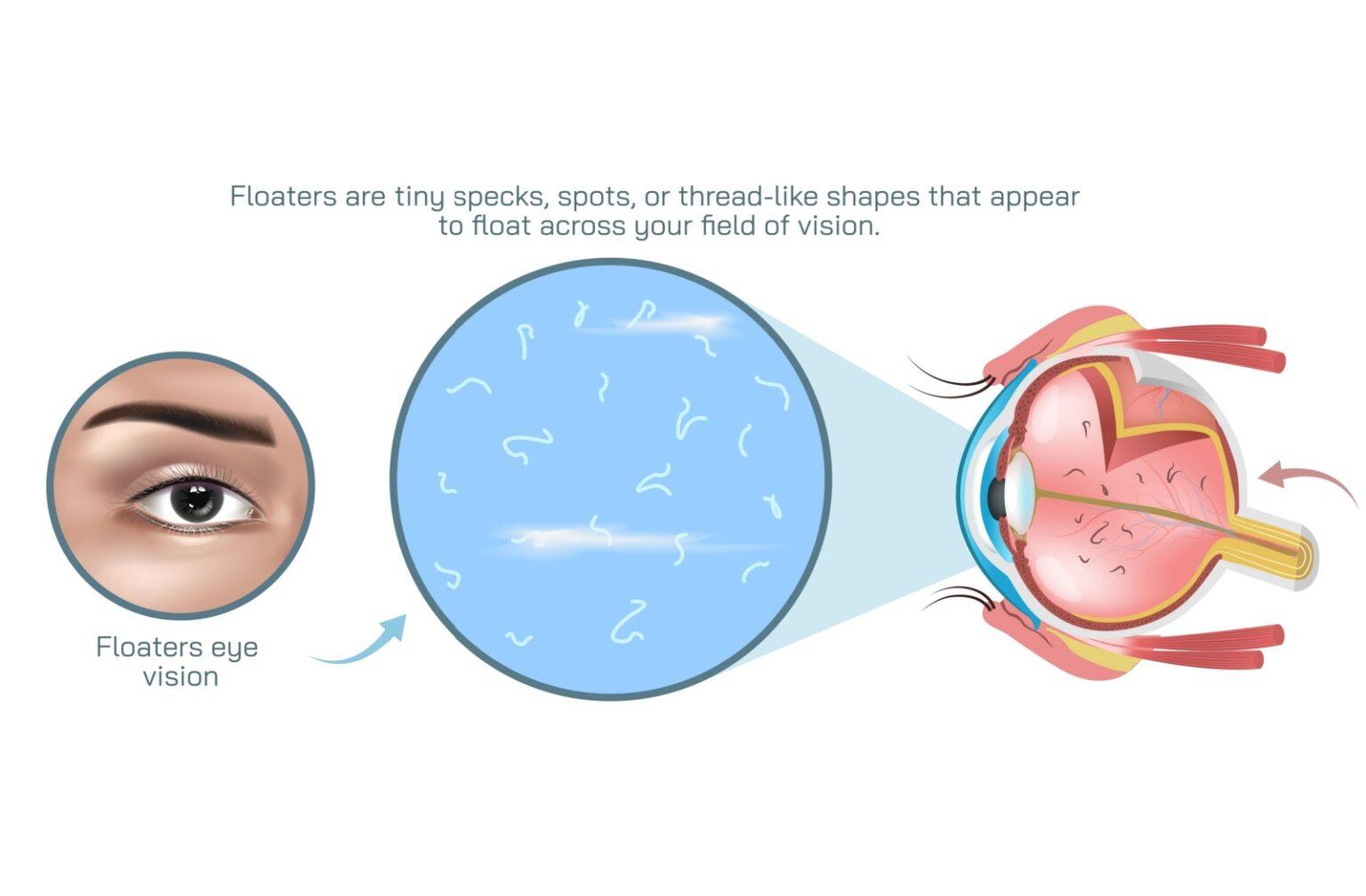 Diagram showing eye floaters as small drifting specks in the field of vision.